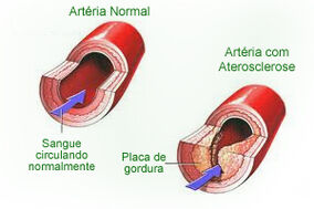 Aterosclerose cópia.jpg