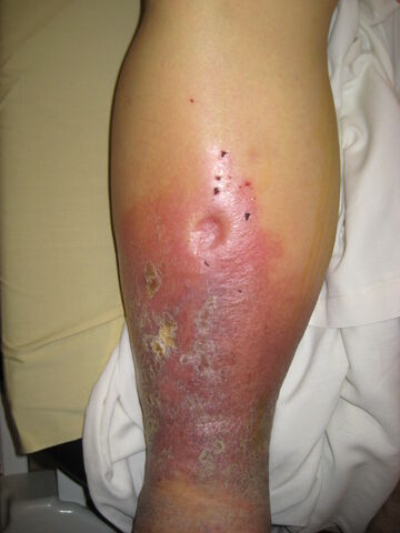 Arquivo:Pitting Edema2008.jpg