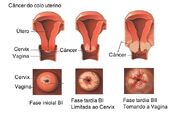 Câncer-colo-uterino.jpg