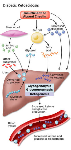 Arquivo:Symptoms-Of-Diabetes-Ketoacidosis.jpg