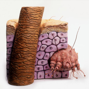 Scabies-1.jpg