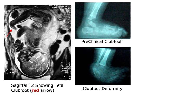 Xrays of Clubfoot vs PCFD