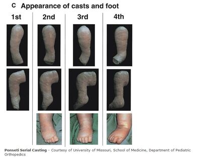 Ponseti Serial Casting