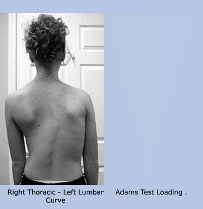 Thoraciclumbercurve