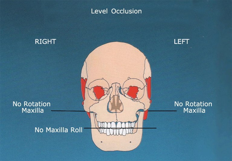 Cross Bite