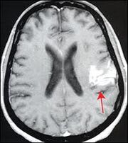 MRI Stroke