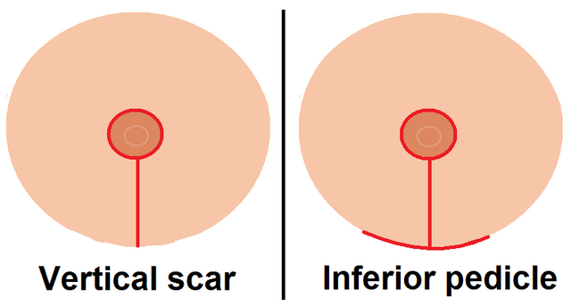 File:Reductiontechniques.png