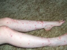 Bites