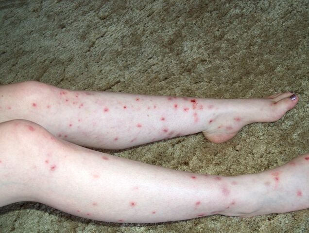 File:Bites.jpg