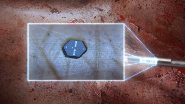 File:Subcutaneous Computer Chip.png