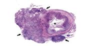 Granuloma1