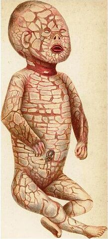 Archivo:Harlequin fetus.jpg