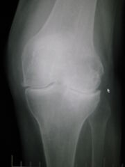 Osteoarthritis left knee
