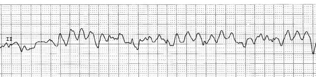 File:EKG VF.jpg