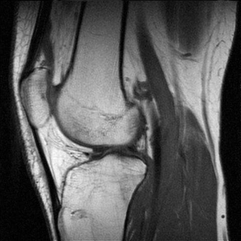 File:MR Knee.jpg
