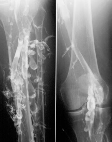 File:Phlebographie mit Thrombose.jpg