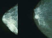 Mammo breast cancer