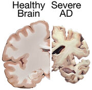 Severe AD
