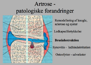 Artrose.png
