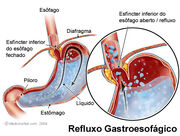 Refluxogastroesofagico.jpg