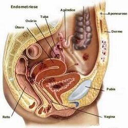 Endometriose fig1.jpg