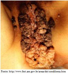 Arquivo:Figura2 HPV.jpg