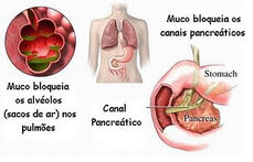 Fig.fibrosecistica.2.jpg.jpg