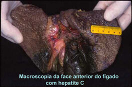 Hepatite.jpg