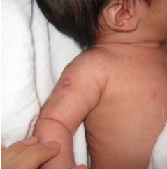Tuberculose7.jpg