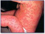 Farmacodermia 03