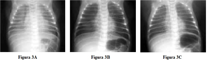 Resp.Neonato 3.jpg