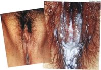 Vulvovaginites4
