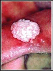 Figura3HPV.jpg
