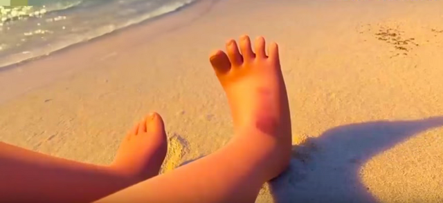 File:Moana-foot-bruise.png