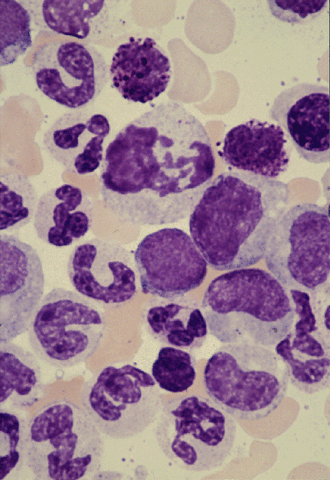 Slika:Leukemia-d-big.gif