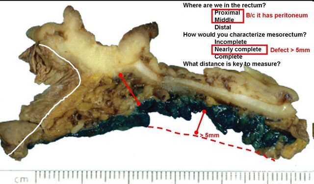 File:Rectum transverse.jpg