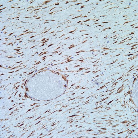 File:Beta-catenin.fibromatosis.2.jpg