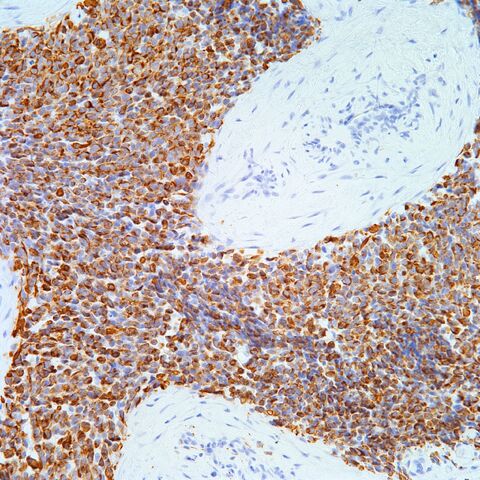 File:Desmin.alveolar rhabdomyosarcoma.3.jpg