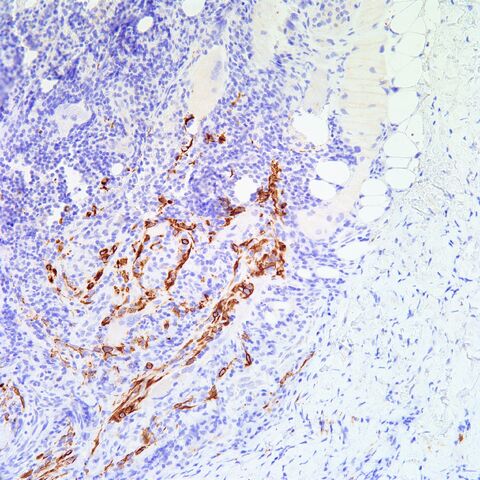 File:AE1-3.cytokeratin.mesothelioma.2.jpg