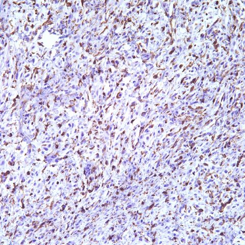 File:Factor XIIIa.13a.PUS.sarcoma.1.jpg