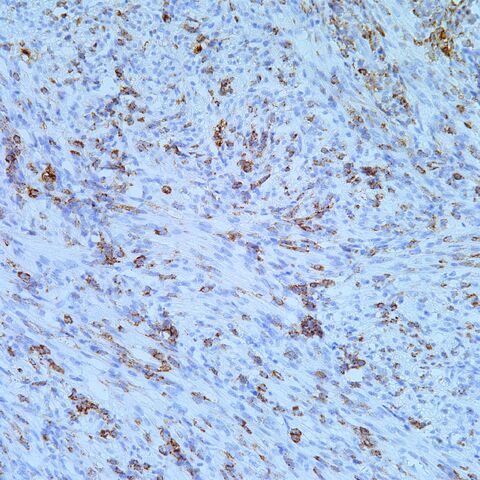 File:Hmb45.AML with cyst.4.jpg