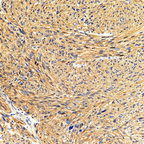 File:MSA.leiomyosarc.HG.1.jpg