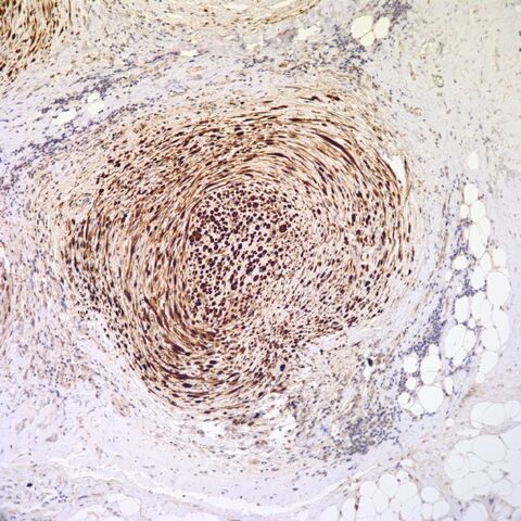File:S100.desmoplastic neurotropic melanoma.10.jpg