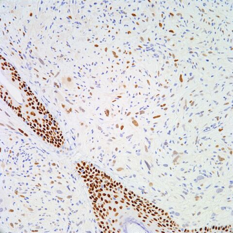File:P63.sarcomatoid squamous cell carcinoma.4.jpg