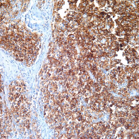 File:PLAP.seminoma.1.jpg