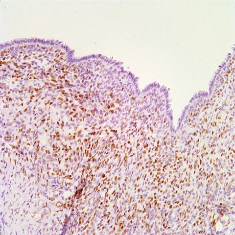 File:ER.AML with cyst.1.jpg