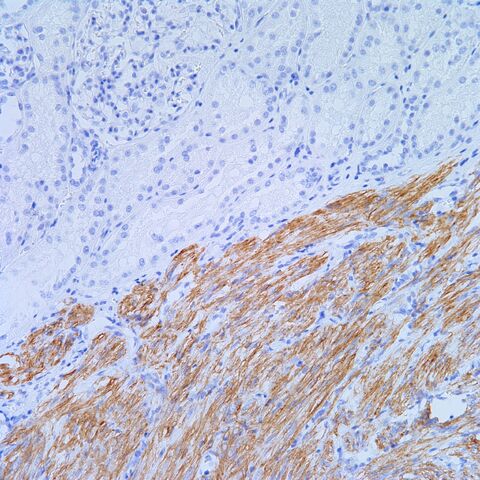 File:Desmin.AML with cyst.1.jpg