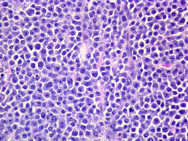 File:Plasmacytoma.jpg