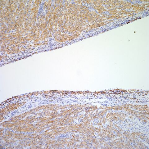 File:Desmin.AML with cyst.4.jpg