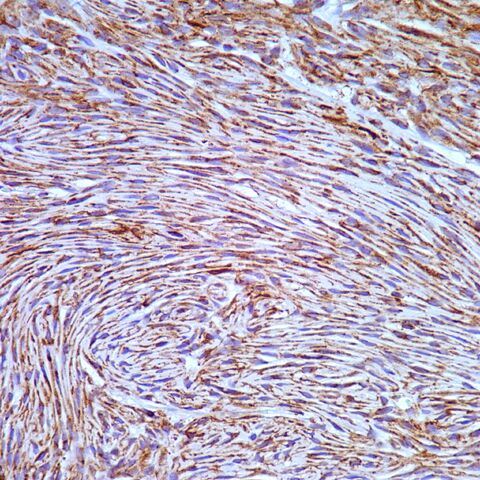File:Claudin-1.perineurioma.400x.3.1..jpg